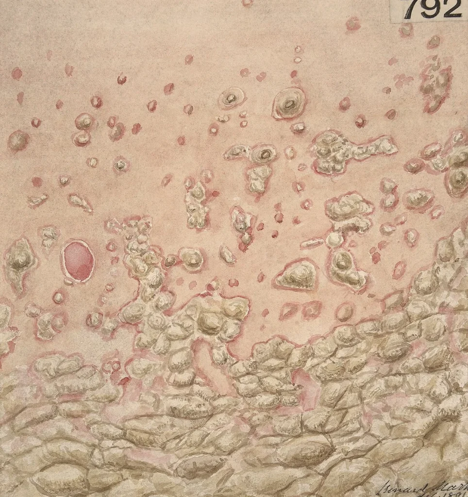 乾癬の皮膚症状を描いた医学的な水彩画