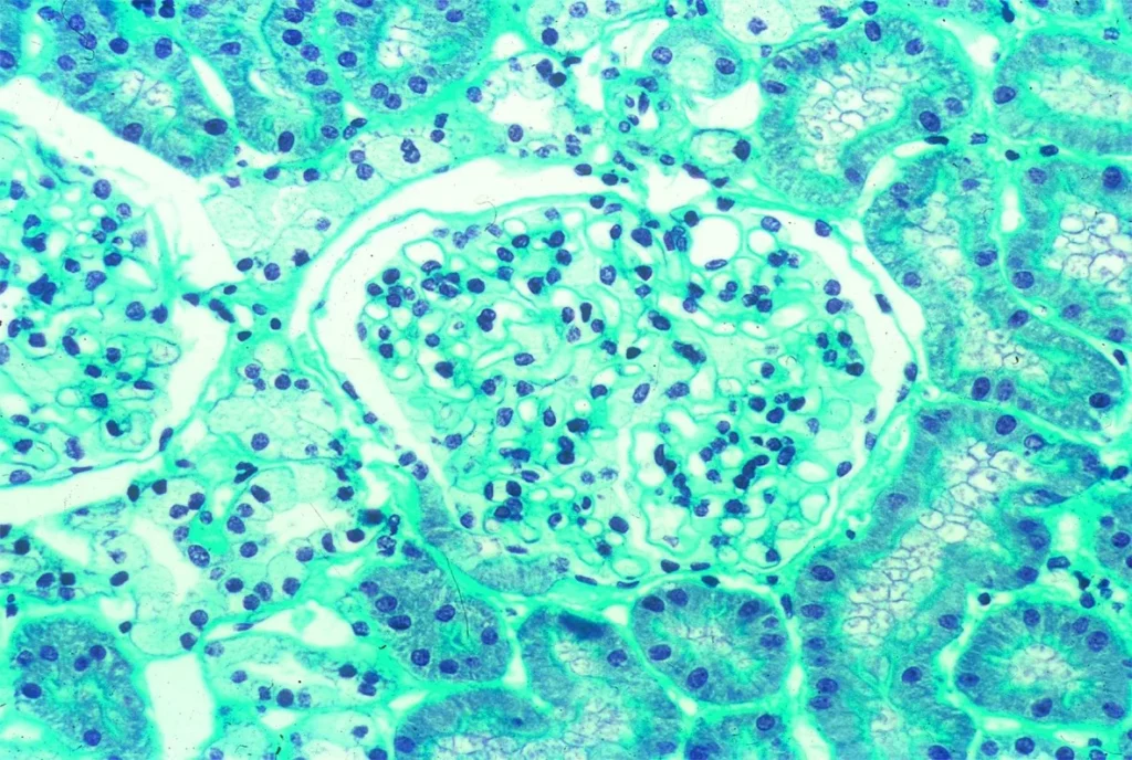 ファブリー病患者の腎臓の生検標本を写した顕微鏡写真