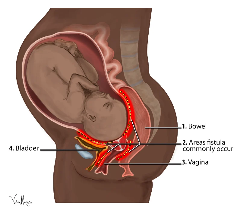 腸、膣、膀胱と産科瘻孔が生じやすい部位を示した図